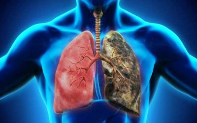Lung Cancer