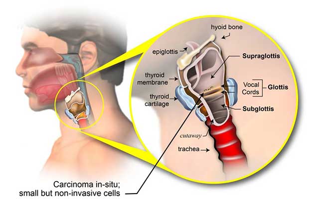 Carcinoma Larynx – Causes, Symptoms and Treatment