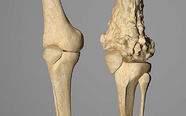 Osteosarcoma