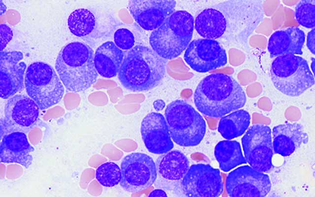 Multiple Myeloma