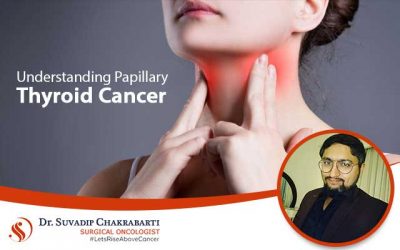 Understanding Papillary Thyroid Cancer: Hear from the Oncologist