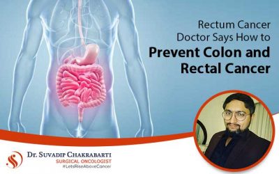 Rectum Cancer Doctor Says How to Prevent Colon and Rectal Cancer