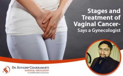 Stages and Treatment of Vaginal Cancer- Says a Gynae Oncologist