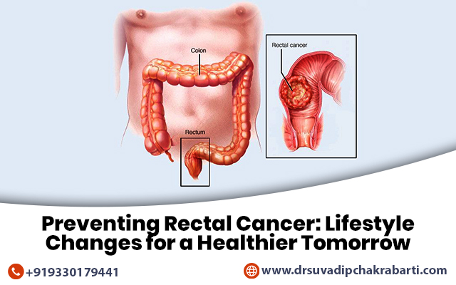 Preventing Rectal Cancer: Lifestyle Changes for a Healthier Tomorrow
