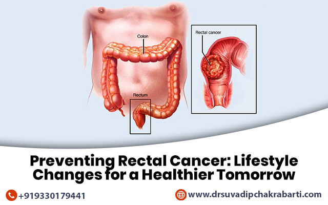 rectal cancer surgeon in Kolkata
