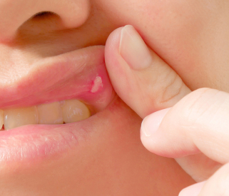 Oral Cavity Cancer / Poor Oral Hygiene / Chronic Irritation