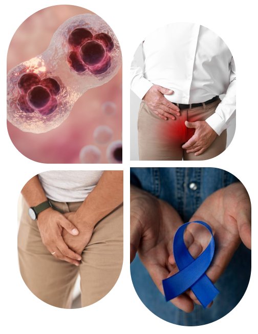 Prostate Cancer-img Prostate Cancer