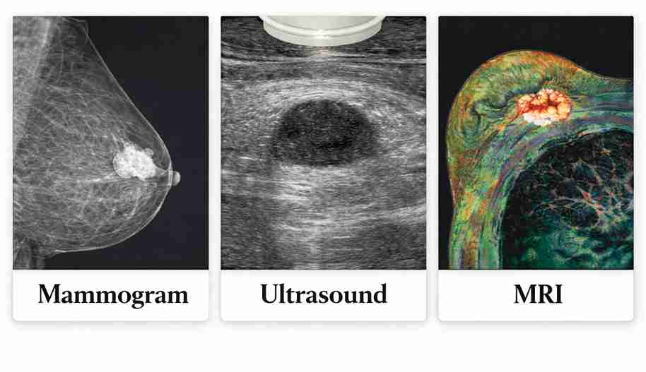 Comparison of mammogram, ultrasound, and MRI scans used for breast cancer detection