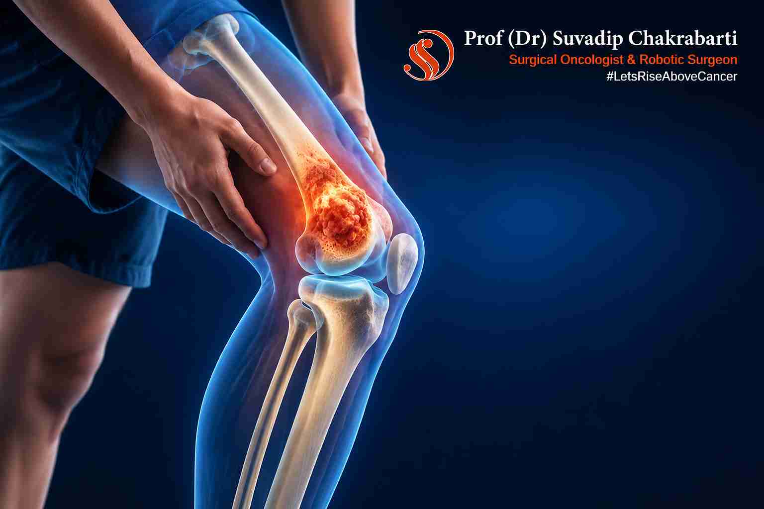 Medical illustration showing an osteosarcoma tumour in the femur near the knee joint.